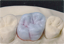 臼歯クラウンの形態回復例